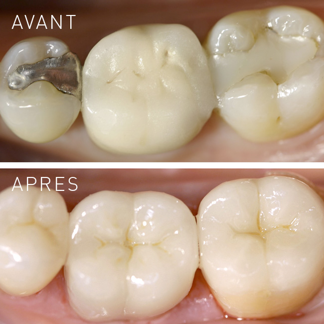 Inlay Ceramique